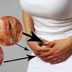 Vaginal Discharge during Pregnancy