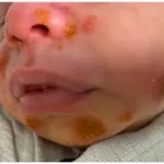 Conjunctivitis in Newborns, Causes, Symptoms, Diagnosis, and Treatment