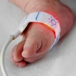 Marfan syndrome in Babies