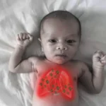 Prader-Willi Syndrome