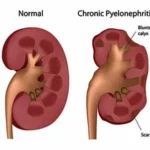 Effects of Kidney Disease in Pregnancy