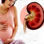 Kidney Infections in Pregnancy