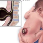 Prader-Willi Syndrome