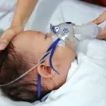 Scars after C-section